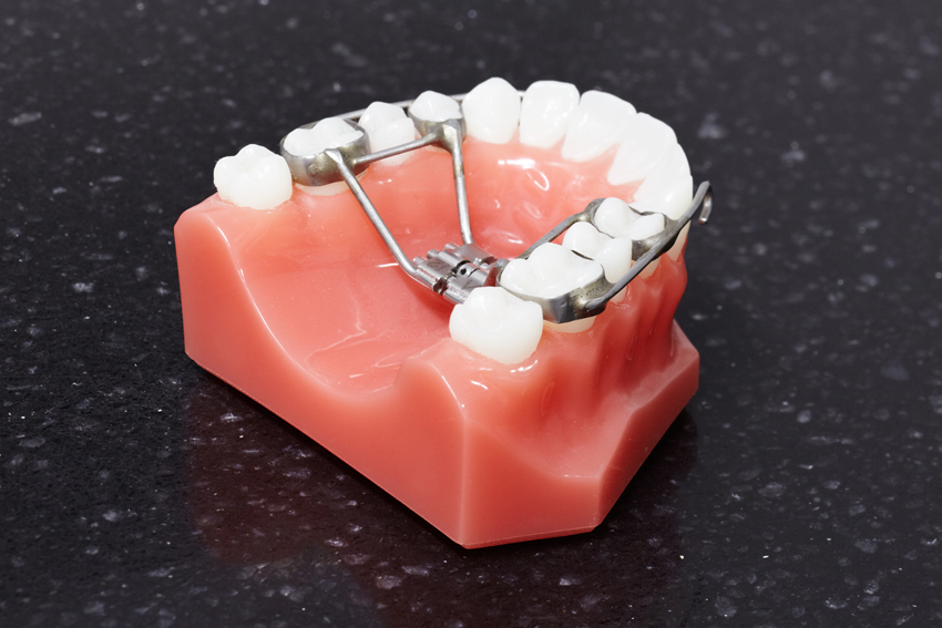 Gaumennahterweiterungsapparatur