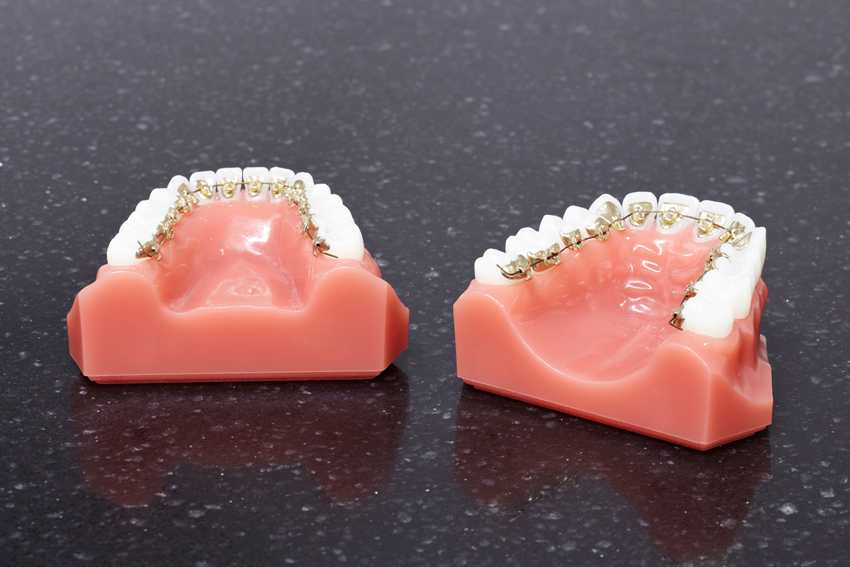 linguale Multibracketapparatur